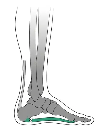 Side view of the foot showing plantar fascia inflammation at the heel