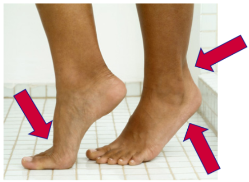 Tiptoe position showing increased forefoot pressure from calf tightness.